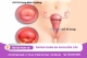 Triệu chứng của bệnh viêm cổ tử cung